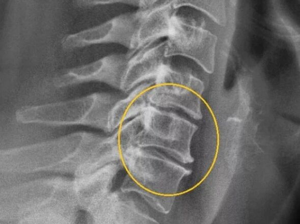 Osteocondrosi della colonna cervicale su un raggio x
