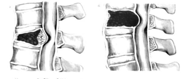 Il tumore alla colonna vertebrale è la causa del mal di schiena