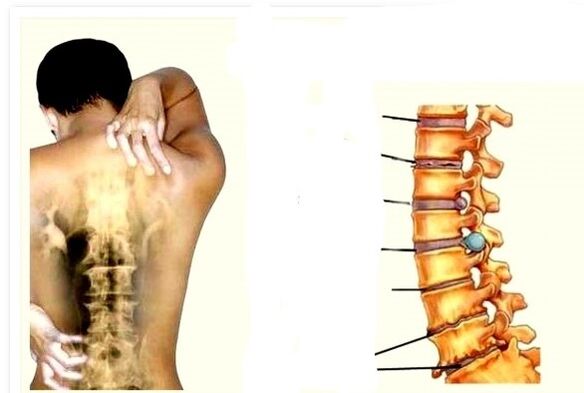 L'osteocondrosi è la causa del mal di schiena