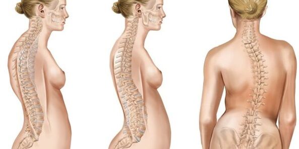 Scoliosi-miscelazione di dischi intervertebrali